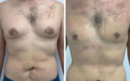 Gynecomastia Surgery in Dubai: How Surgeons Ensure Safe Outcomes