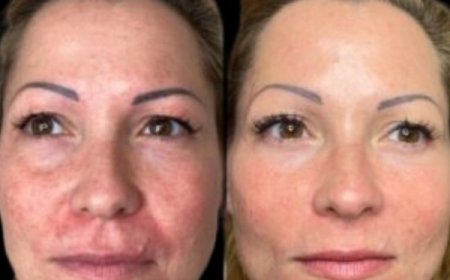 Refine Elegance by Best Doctors in dubai using Profhilo