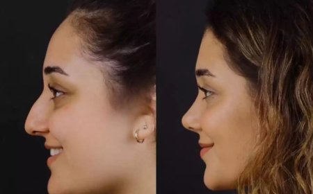 Choosing Among the Best Septoplasty Surgeons in Dubai: What to Ask