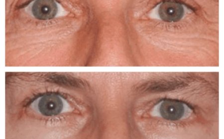 Eye Bag Removal Surgery in Dubai: A Step-by-Step Process Explained by Top Surgeons