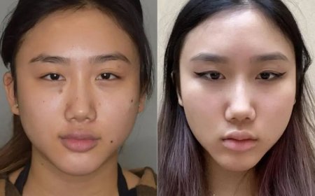 Buccal fat removal Surgery in Dubai and Face Shape Analysis