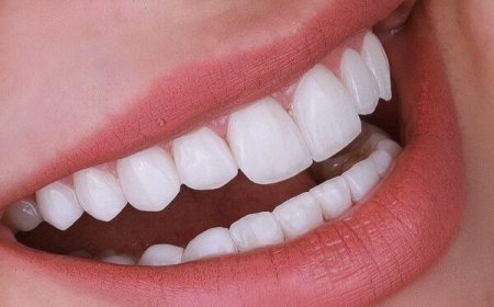 Enhance Your Smile with Dental Veneers in Dubai