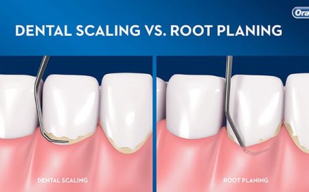 Dental Scaling: A Vital Step Toward Better Oral Health