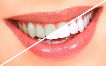 Teeth Whitening Dubai: Brighten Your Smile in the Heart of the UAE