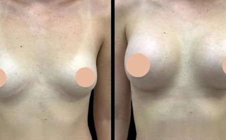 Implant Options Offered by the Best Breast Augmentation Surgeons in Dubai