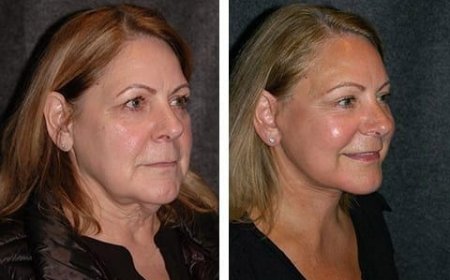 Reclaim Youthful Contours: The Complete Guide to the SMAS Facelift