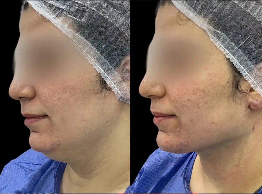 Chin Fillers Treatments in Dubai: Combining with Skin Tightening Procedures
