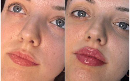 Juvederm Treatments in Dubai for Lip Enhancement