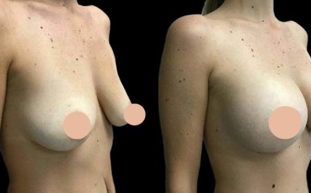 How the Best Breast Augmentation Surgeon in Dubai Can Help with Post-Surgery Recovery