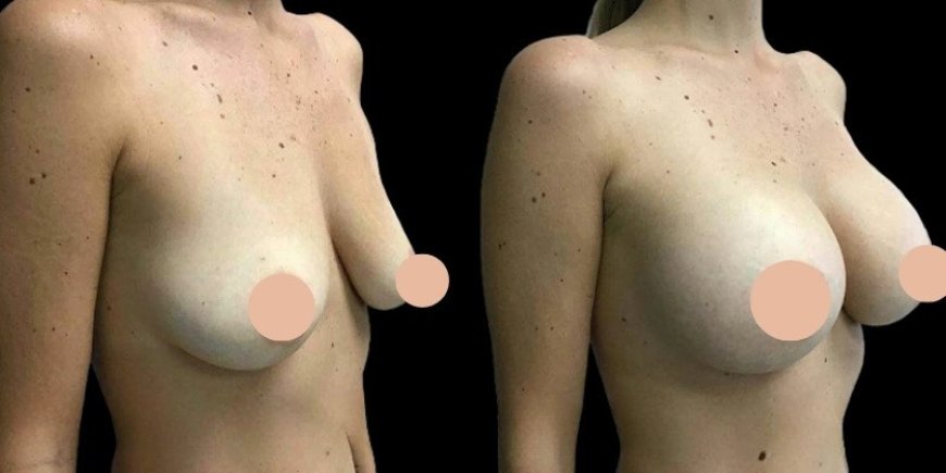 The Role of the Best Doctors in Dubai in Achieving Long-Lasting Breast Augmentation Results
